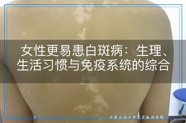 女性更易患白斑病：生理、生活习惯与免疫系统的综合影响