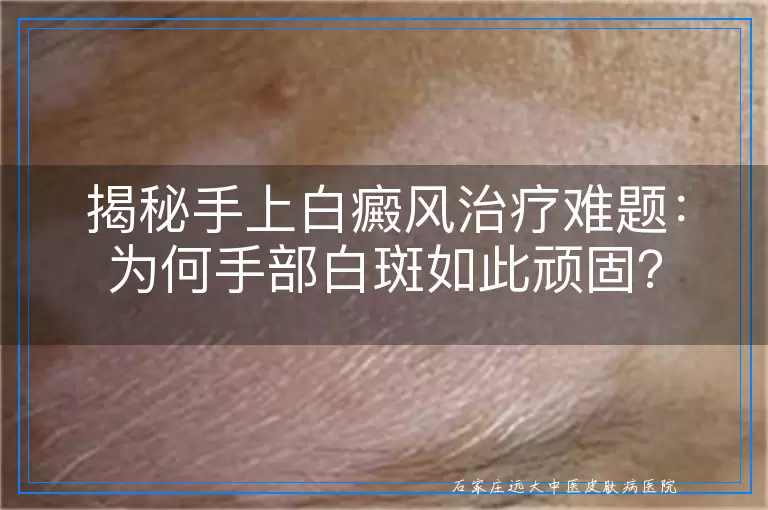 揭秘手上白癜风治疗难题：为何手部白斑如此顽固？