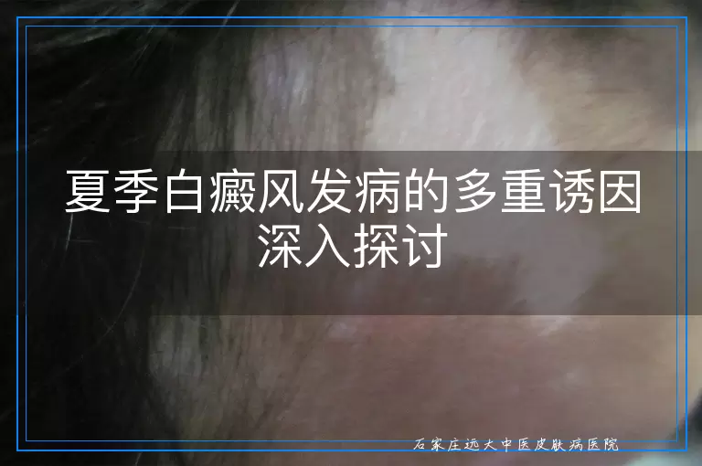 夏季白癜风发病的多重诱因深入探讨