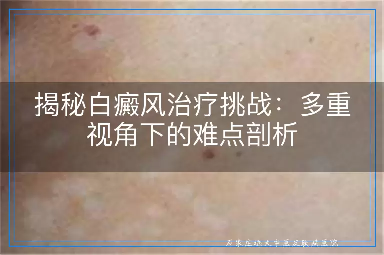 揭秘白癜风治疗挑战：多重视角下的难点剖析