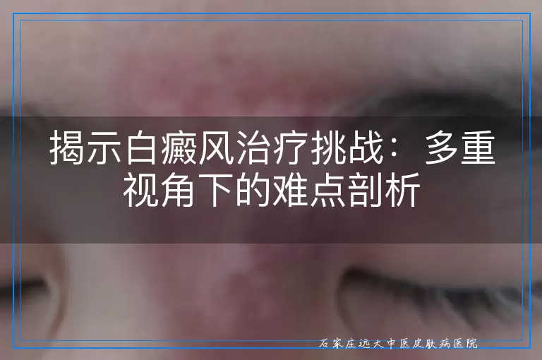揭示白癜风治疗挑战：多重视角下的难点剖析