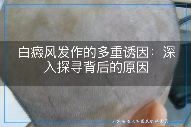 白癜风发作的多重诱因：深入探寻背后的原因
