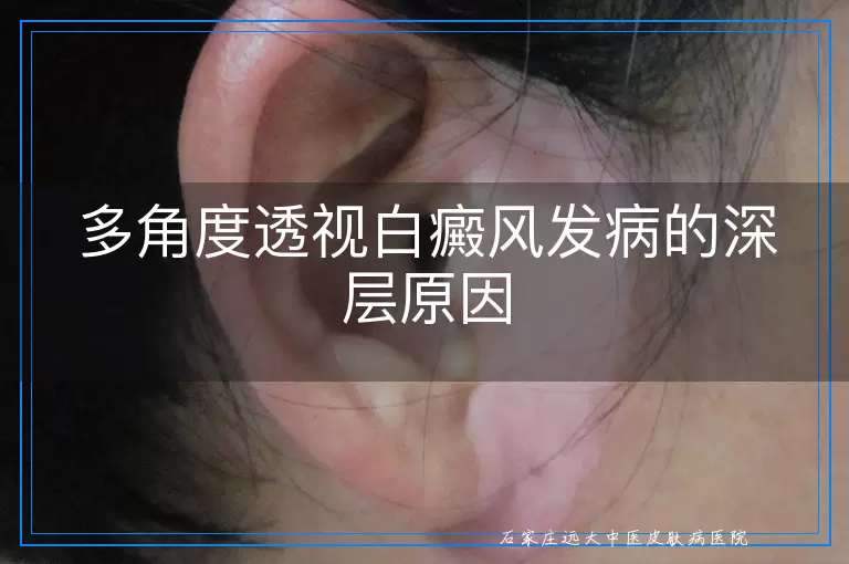 多角度透视白癜风发病的深层原因