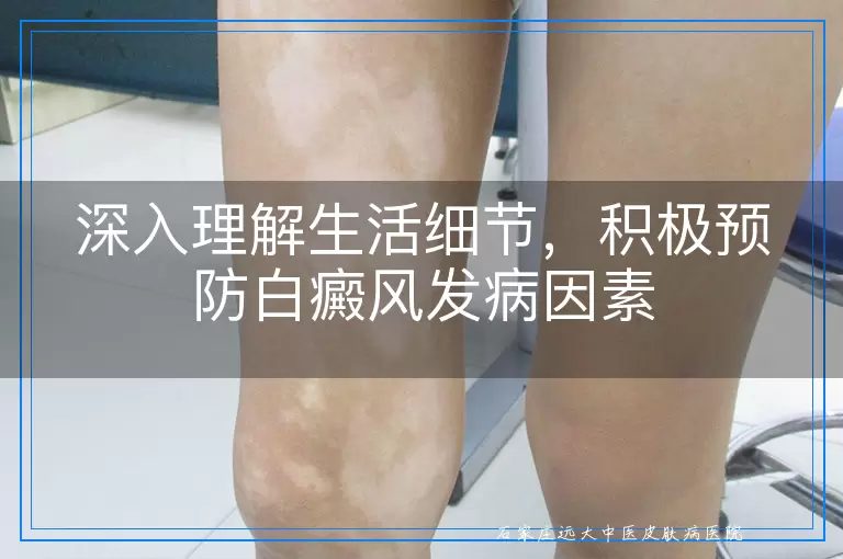 深入理解生活细节，积极预防白癜风发病因素