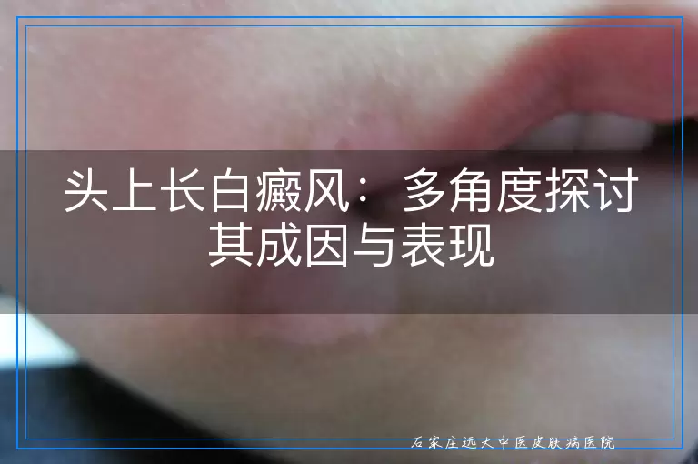 头上长白癜风：多角度探讨其成因与表现