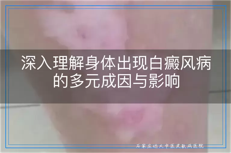 深入理解身体出现白癜风病的多元成因与影响