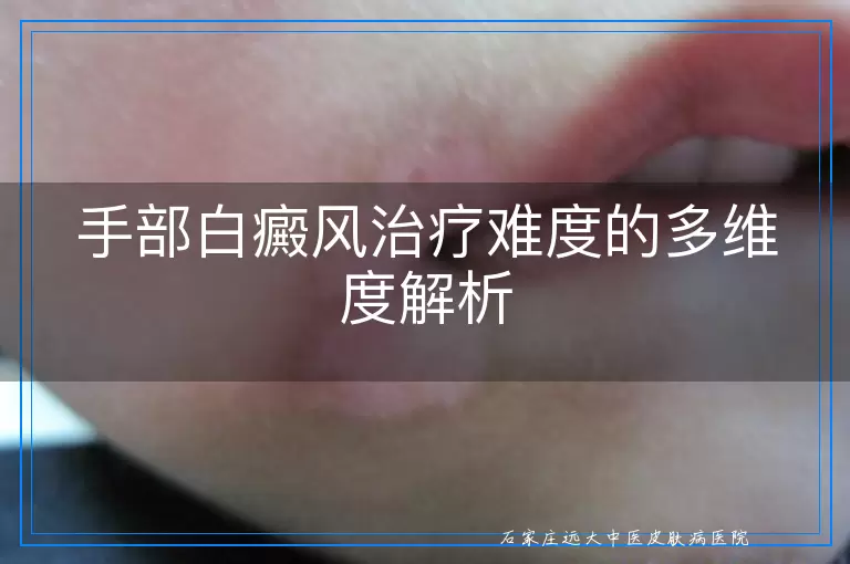 手部白癜风治疗难度的多维度解析