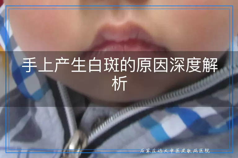 手上产生白斑的原因深度解析