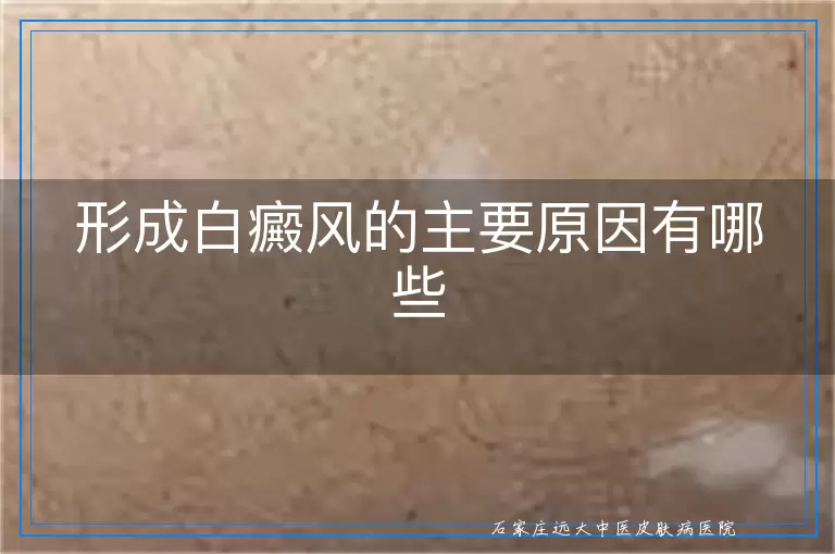 形成白癜风的主要原因有哪些