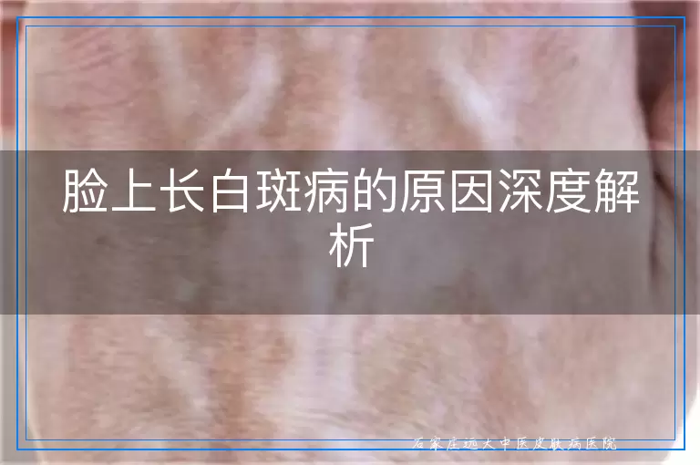 脸上长白斑病的原因深度解析