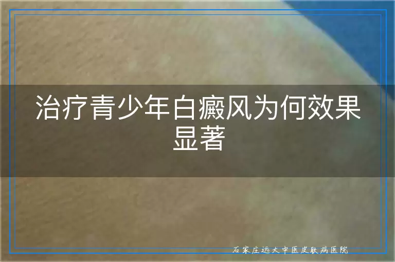 治疗青少年白癜风为何效果显著