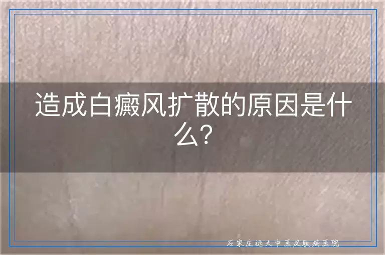造成白癜风扩散的原因是什么？