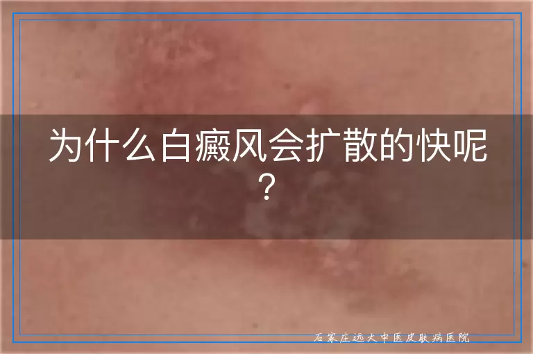 为什么白癜风会扩散的快呢？