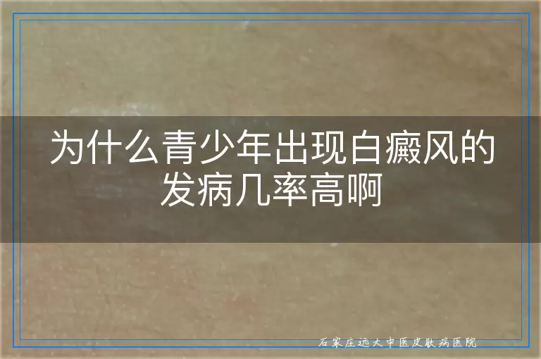 为什么青少年出现白癜风的发病几率高啊