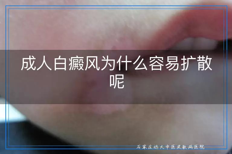 成人白癜风为什么容易扩散呢