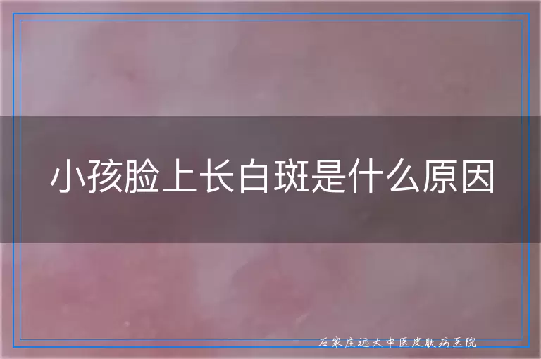 小孩脸上长白斑是什么原因