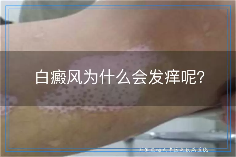白癜风为什么会发痒呢？
