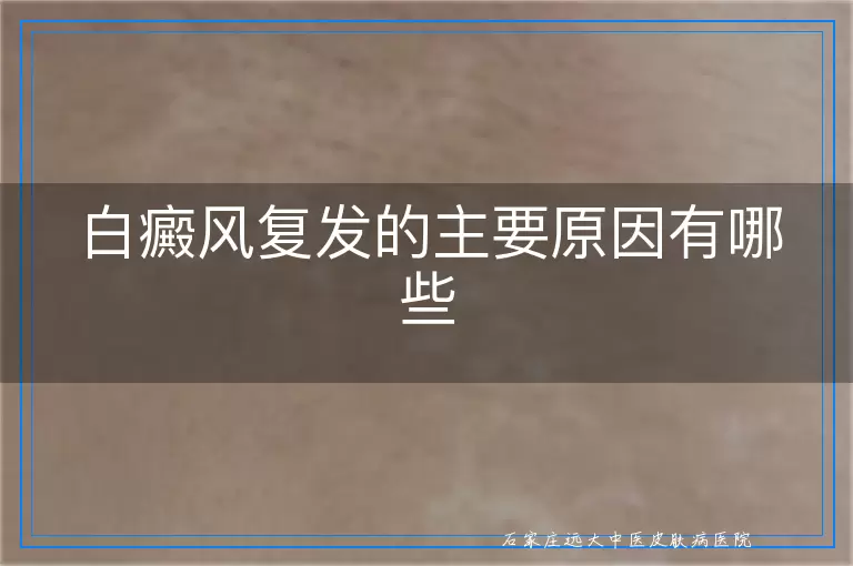 白癜风复发的主要原因有哪些