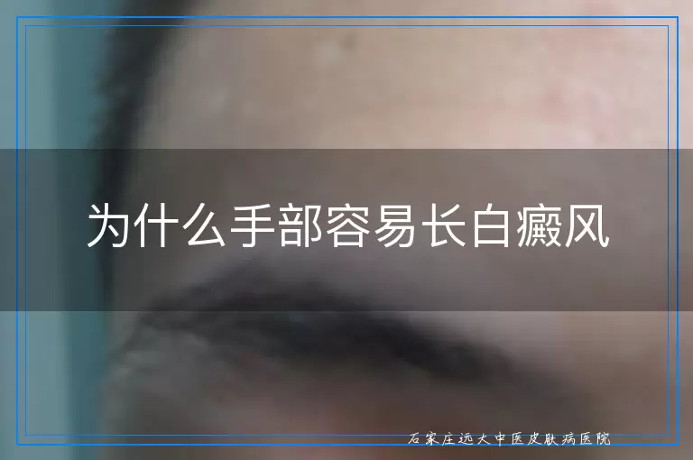为什么手部容易长白癜风