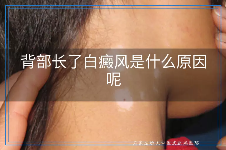 背部长了白癜风是什么原因呢
