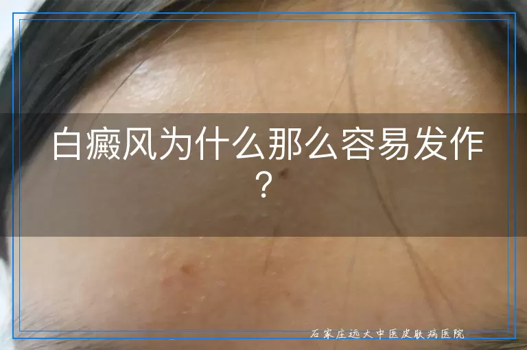 白癜风为什么那么容易发作？