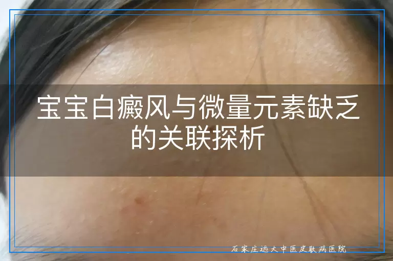 宝宝白癜风与微量元素缺乏的关联探析