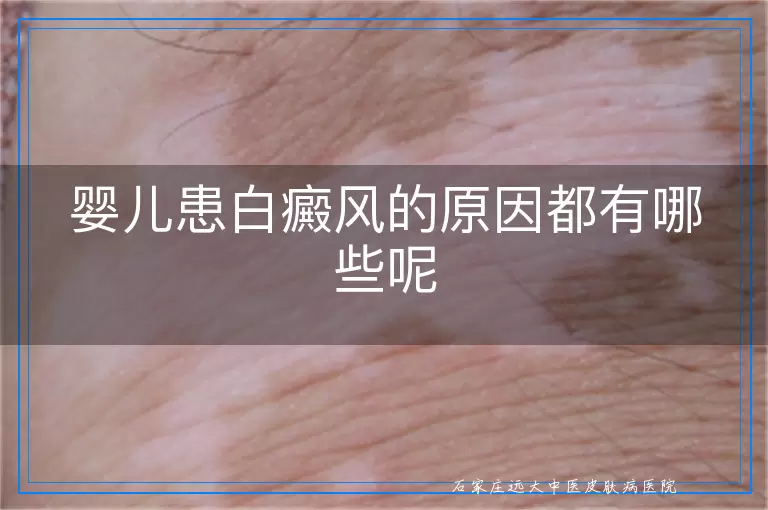 婴儿患白癜风的原因都有哪些呢