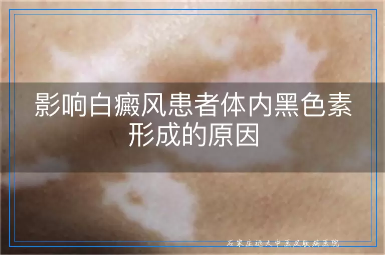 影响白癜风患者体内黑色素形成的原因