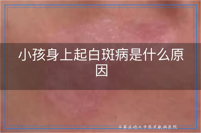 小孩身上起白斑病是什么原因