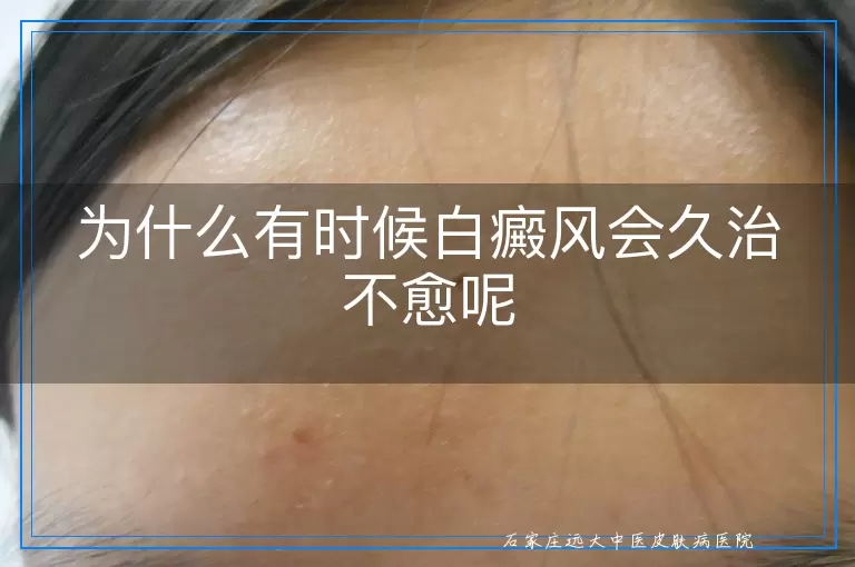 为什么有时候白癜风会久治不愈呢