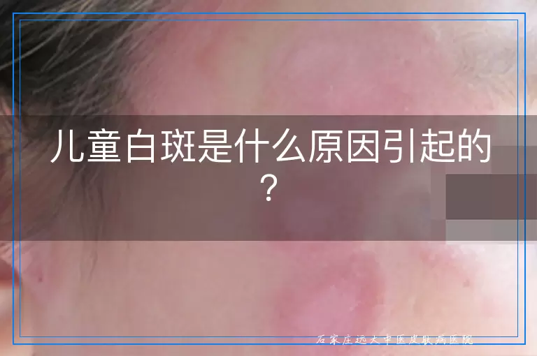 儿童白斑是什么原因引起的？