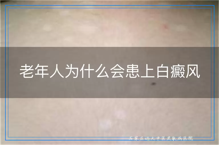 老年人为什么会患上白癜风