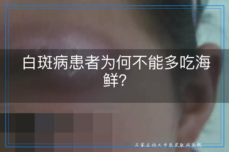 白斑病患者为何不能多吃海鲜？