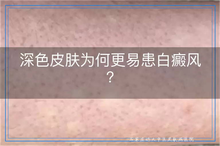 深色皮肤为何更易患白癜风？