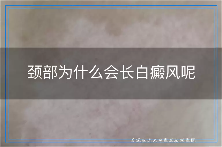 颈部为什么会长白癜风呢