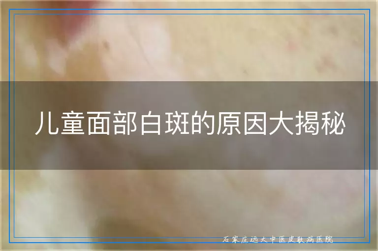 儿童面部白斑的原因大揭秘
