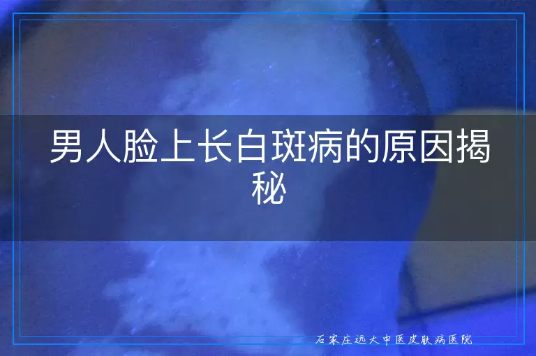 男人脸上长白斑病的原因揭秘