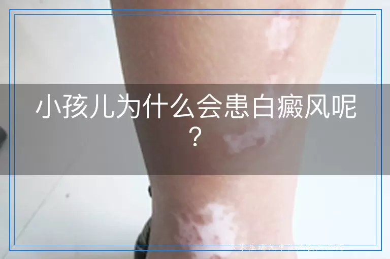 小孩儿为什么会患白癜风呢？