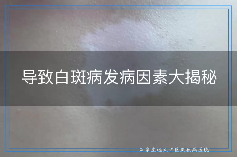 导致白斑病发病因素大揭秘