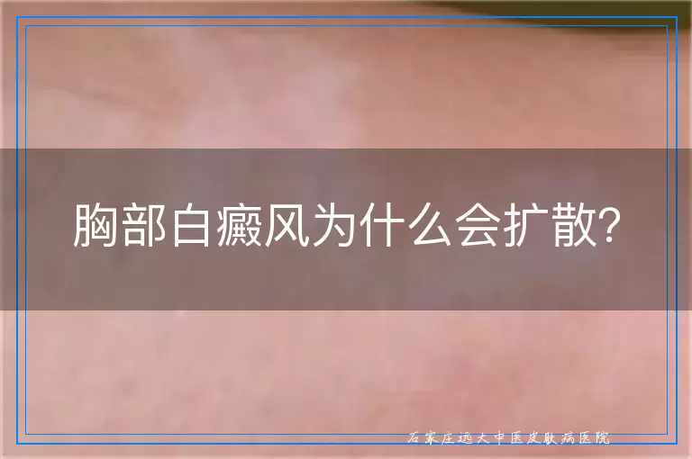 胸部白癜风为什么会扩散？