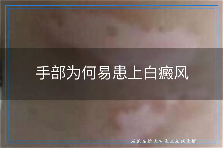 手部为何易患上白癜风