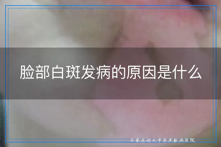 脸部白斑发病的原因是什么