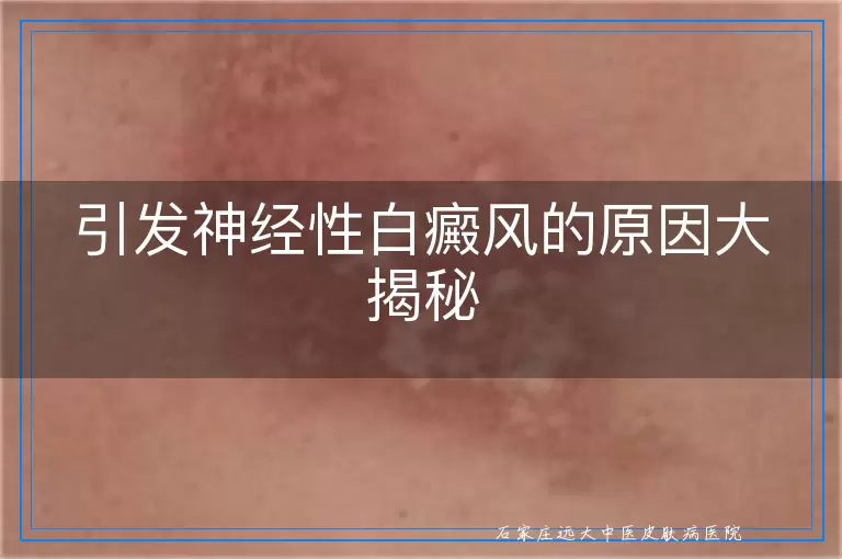 引发神经性白癜风的原因大揭秘