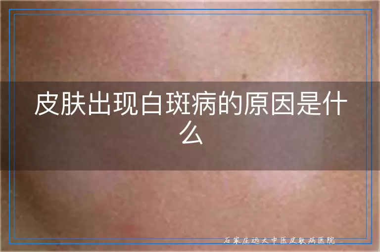 皮肤出现白斑病的原因是什么