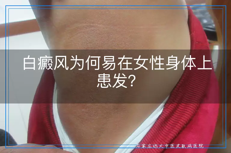 白癜风为何易在女性身体上患发？