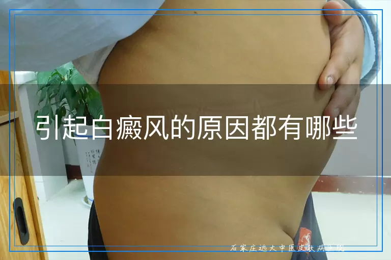 引起白癜风的原因都有哪些