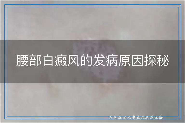 腰部白癜风的发病原因探秘