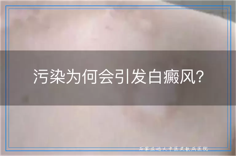 污染为何会引发白癜风？