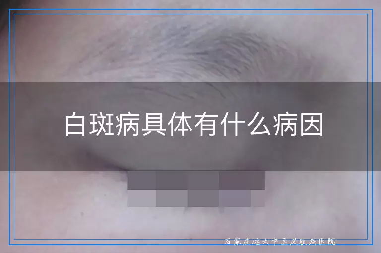 白斑病具体有什么病因