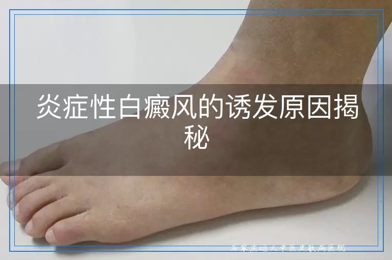 炎症性白癜风的诱发原因揭秘